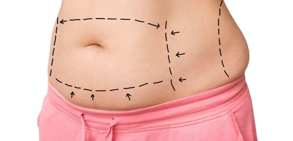 Abdominoplastika\mini abdominoplastika