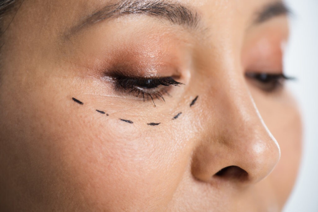 Alt /üst göz qapaği əməliyyati (blefaroplastika)